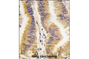 Formalin-fixed and paraffin-embedded human lung carcinoma tissue reacted with FRAT1 antibody , which was peroxidase-conjugated to the secondary antibody, followed by DAB staining. (FRAT1 antibody  (C-Term))