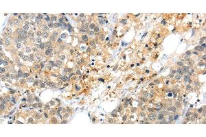 Immunohistochemistry of paraffin-embedded Human liver cancer tissue using KCNG3 Polyclonal Antibody at dilution 1:40