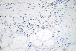 Immunohistochemistry was performed on paraffin-embedded human sigmoid colon carcinoma using ADAM17 antibody (ABIN7797502), 1:200).