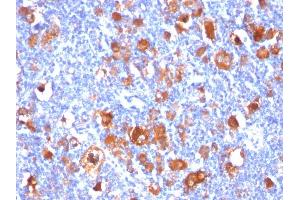 Formalin-fixed, paraffin-embedded human Hodgkin's Lymphoma stained with Fascin-1 Mouse Monoclonal Antibody (FSCN1/418). (Fascin antibody)