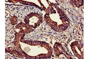 Immunohistochemistry of paraffin-embedded human colon cancer using ABIN7147780 at dilution of 1:100 (CNTF Receptor alpha antibody  (AA 106-342))