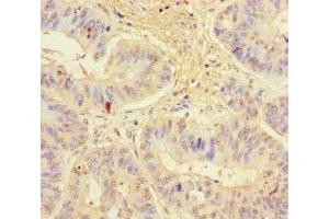 Immunohistochemistry of paraffin-embedded human colon cancer using ABIN7157538 at dilution of 1:100 (KLRG1 antibody  (AA 60-195))