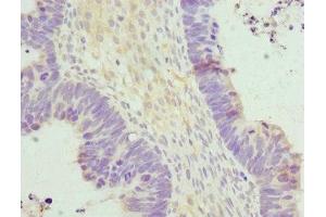 Immunohistochemistry of paraffin-embedded human ovarian cancer using ABIN7155889 at dilution of 1:100