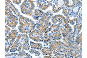 The image on the left is immunohistochemistry of paraffin-embedded Human thyroid cancer tissue using ABIN7190321(COG1 Antibody) at dilution 1/60, on the right is treated with synthetic peptide. (COG1 antibody)