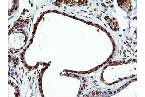 Immunohistochemical staining of paraffin-embedded Human breast tissue using anti-EPM2AIP1 mouse monoclonal antibody. (EPM2AIP1 antibody)