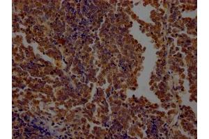 IHC image of ABIN7127651 diluted at 1:100 and staining in paraffin-embedded human lung cancer performed on a Leica BondTM system. (Recombinant OGT antibody)