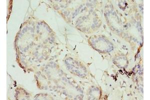 Immunohistochemistry of paraffin-embedded human breast cancer using ABIN7170565 at dilution of 1:100 (S1PR1 antibody  (AA 311-382))