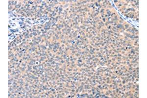 The image on the left is immunohistochemistry of paraffin-embedded Human cervical cancer tissue using ABIN7128109(AADACL2 Antibody) at dilution 1/25, on the right is treated with fusion protein. (AADACL2 antibody)