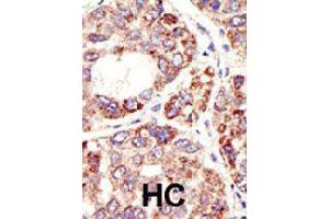 Formalin-fixed and paraffin-embedded human hepatocellular carcinoma tissue reacted with MDM2 polyclonal antibody  , which was peroxidase-conjugated to the secondary antibody, followed by DAB staining. (MDM2 antibody  (C-Term))