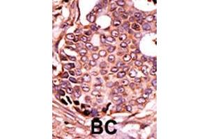 Formalin-fixed and paraffin-embedded human cancer tissue reacted with the primary antibody, which was peroxidase-conjugated to the secondary antibody, followed by DAB staining. (SEPSH2 antibody  (AA 171-201))