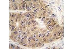 IHC analysis of FFPE human hepatocarcinoma tissue stained with SUMO4 antibody (SUMO4 antibody  (Met55Val-Mutant))