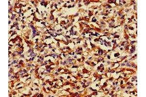 Immunohistochemistry of paraffin-embedded human melanoma using ABIN7168489 at dilution of 1:100 (RUNX3 antibody  (AA 1-415))
