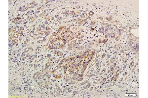 Formalin-fixed and paraffin embedded human pancreatic cancer labeled with Anti-EDG7/LPA3 Polyclonal Antibody, Unconjugated (ABIN681133) at 1:400 followed by conjugation to the secondary antibody and DAB staining