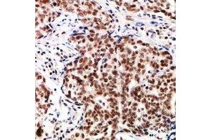 Immunohistochemical analysis of TP53INP2 staining in human breast cancer formalin fixed paraffin embedded tissue section. (TP53INP2 antibody  (N-Term))