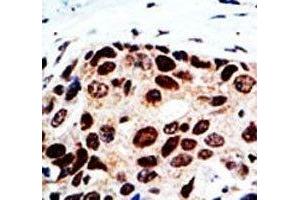 IHC analysis of FFPE human breast cancer tissue stained with the HDAC9 antibody