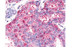 Anti-HNF4G / HNF4 Gamma antibody IHC of human Breast, Carcinoma. (HNF4 gamma antibody  (Internal Region))