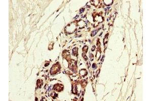 IHC image of ABIN7159059 diluted at 1:300 and staining in paraffin-embedded human breast cancer performed on a Leica BondTM system. (MGP antibody  (AA 20-96))