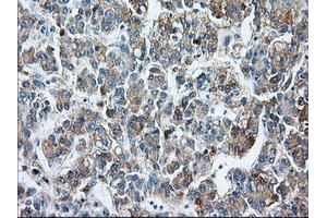Immunohistochemical staining of paraffin-embedded Carcinoma of liver tissue using anti-BSG mouse monoclonal antibody. (CD147 antibody)