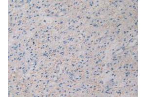 DAB staining on IHC-P; Samples: Human Glioma Tissue. (GHRH antibody  (AA 19-108))