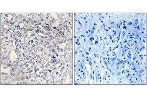 Immunohistochemistry analysis of paraffin-embedded human liver carcinoma tissue, using Heparin Cofactor II Antibody. (SERPIND1 antibody  (AA 41-90))