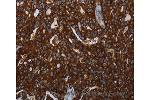 Immunohistochemistry of Human esophagus cancer using KISS1R Polyclonal Antibody at dilution of 1:30