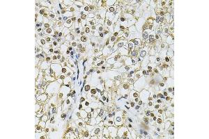 Immunohistochemistry of paraffin-embedded human kidney cancer using IFI16 Antibody (ABIN6129036, ABIN6142162, ABIN6142163 and ABIN6218202) at dilution of 1:100 (40x lens).