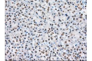 Immunohistochemical staining of paraffin-embedded Adenocarcinoma of Human colon tissue using anti-CYP1A2 mouse monoclonal antibody.