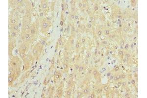 Immunohistochemistry of paraffin-embedded human liver tissue using ABIN7155892 at dilution of 1:100 (HGD antibody  (AA 226-445))