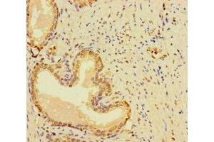 Immunohistochemistry of paraffin-embedded human prostate cancer using ABIN7166969 at dilution of 1:100 (RABEP2 antibody  (AA 301-533))