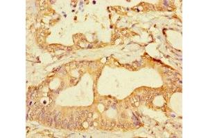 Immunohistochemistry of paraffin-embedded human colon cancer using ABIN7153335 at dilution of 1:100 (GPR183 antibody  (AA 1-31))