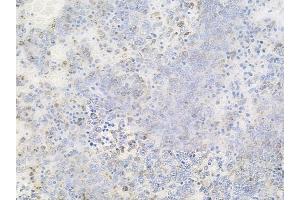 ABIN6256556 and ABIN6267493 at 1/100 staining human melanoma by IHC-P. (MEK2 antibody  (pThr394))