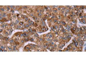 Immunohistochemistry of paraffin-embedded Human liver cancer tissue using HSP10 Polyclonal Antibody at dilution 1:40 (HSPE1 antibody)