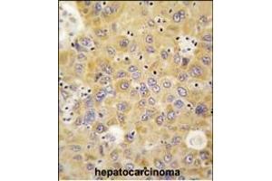 Formalin-fixed and paraffin-embedded human hepatocarcinoma tissue reacted with RS antibody (N-term) (ABIN391804 and ABIN2841658) , which was peroxidase-conjugated to the secondary antibody, followed by DAB staining. (AARS antibody  (N-Term))