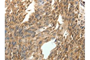 The image on the left is immunohistochemistry of paraffin-embedded Human ovarian cancer tissue using ABIN7131276(SYT7 Antibody) at dilution 1/15, on the right is treated with fusion protein. (SYT7 antibody)