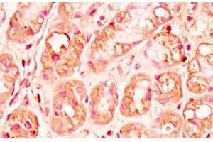 Human stomach cancer tissue was stained by rabbit Anti-Spexin prepro (73-116)  (H) Antibody (Spexin antibody  (Preproprotein))