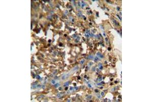 Formalin fixed and paraffin embedded human breast carcinoma  reacted WITH DMP4 Antibody (C-term) followed by peroxidase conjugation of the secondary antibody and DAB staining.
