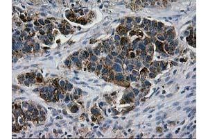 Immunohistochemical staining of paraffin-embedded Carcinoma of Human lung tissue using anti-LGALS3BP mouse monoclonal antibody. (LGALS3BP antibody  (AA 19-300))