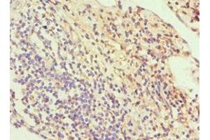 Immunohistochemistry of paraffin-embedded human cervical cancer using ABIN7170114 at dilution of 1:100 (GLUT1 antibody  (AA 210-310))