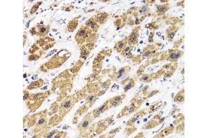 Immunohistochemistry of paraffin-embedded Human liver cancer using HAPLN1 Polyclonal Antibody at dilution of 1:100 (40x lens).