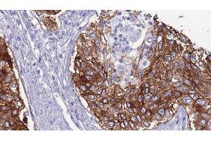 ABIN6276794 at 1/100 staining Human urothelial cancer tissue by IHC-P. (CD46 antibody  (N-Term))