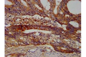 IHC image of ABIN7168210 diluted at 1:400 and staining in paraffin-embedded human colon cancer performed on a Leica BondTM system. (SBDS antibody  (AA 37-153))