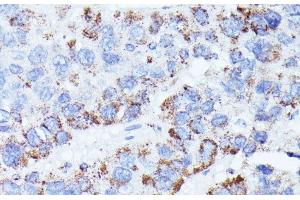 Immunohistochemistry of paraffin-embedded Human liver cancer using CCDC6 Polyclonal Antibody at dilution of 1:100 (40x lens). (CCDC6 antibody)