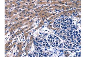 The image on the left is immunohistochemistry of paraffin-embedded Human liver cancer tissue using ABIN7129604(GIP Antibody) at dilution 1/13, on the right is treated with fusion protein. (GIP antibody)