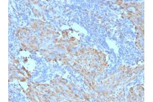 Formalin-fixed, paraffin-embedded human GIST stained with CD117 Mouse Monoclonal Antibody (C117/370). (KIT antibody)