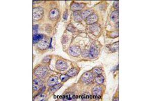 Formalin-fixed and paraffin-embedded human breast carcinoma tissue reacted with CDH13 antibody , which was peroxidase-conjugated to the secondary antibody, followed by DAB staining. (Cadherin 13 antibody  (C-Term))