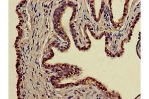 Immunohistochemistry of paraffin-embedded human prostate cancer using ABIN7155629 at dilution of 1:100 (BBX antibody  (AA 62-292))