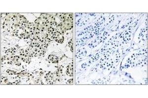 Immunohistochemistry analysis of paraffin-embedded human breast carcinoma tissue, using THOC5 Antibody. (THO Complex 5 antibody  (AA 561-610))