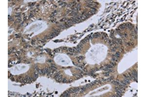 The image on the left is immunohistochemistry of paraffin-embedded Human colon cancer tissue using ABIN7129632(GNG2 Antibody) at dilution 1/60, on the right is treated with fusion protein. (GNG2 antibody)