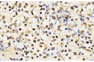 Immunohistochemistry of paraffin-embedded Human kidney cancer using MonoMethyl-Histone H3-K27 Polyclonal Antibody at dilution of 1:200 (40x lens). (Histone 3 antibody  (meLys27))