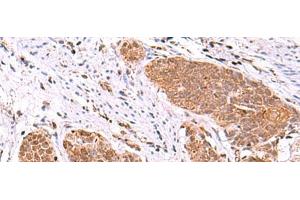 Immunohistochemistry of paraffin-embedded Human esophagus cancer tissue using ASTN2 Polyclonal Antibody at dilution of 1:80(x200) (Astrotactin 2 antibody)